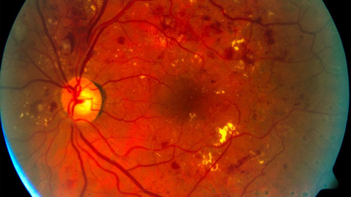 Augenschäden häufige Komplikation bei Diabetes