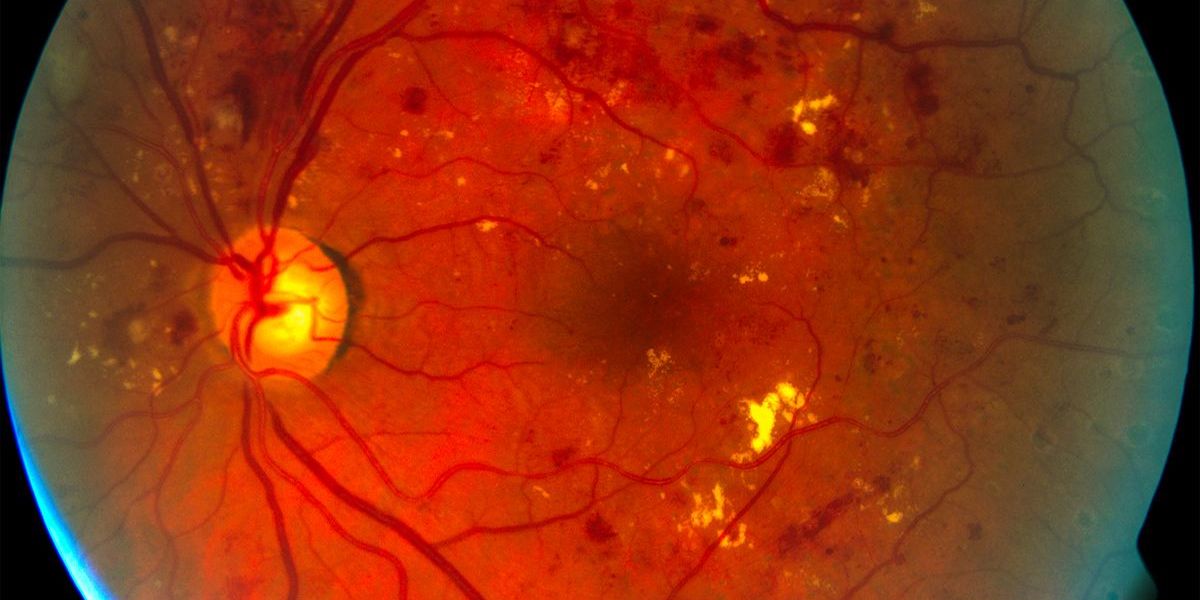 Augenschäden häufige Komplikation bei Diabetes Augenschäden häufige Komplikation bei Diabetes