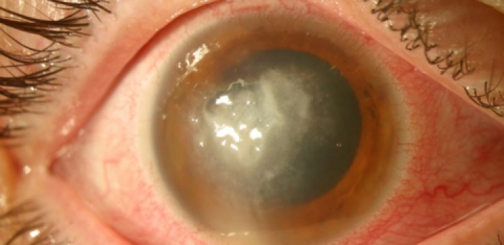 Wissenschaftler informieren im Rahmen der Kontaktlinsenwoche